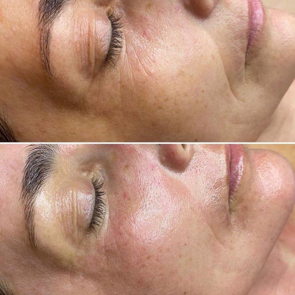 Mikrojehličkování